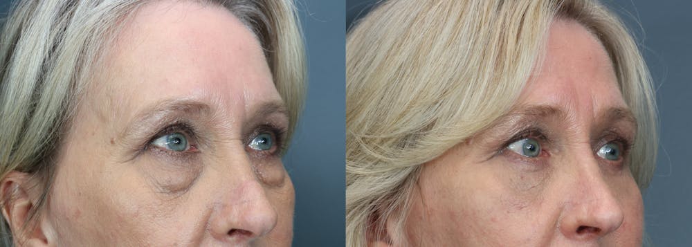 Eyelid Surgery Before & After Gallery - Patient 504225 - Image 3