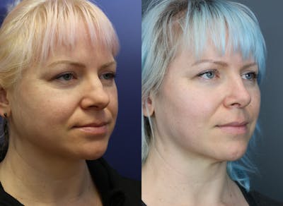 Rhinoplasty (Nose Reshaping) Before & After Gallery - Patient 378971 - Image 1