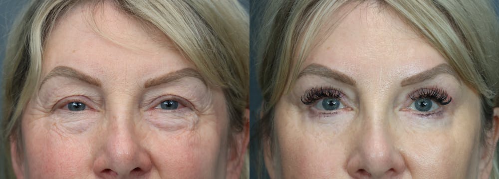 Eyelid Surgery Before & After Gallery - Patient 195436 - Image 1