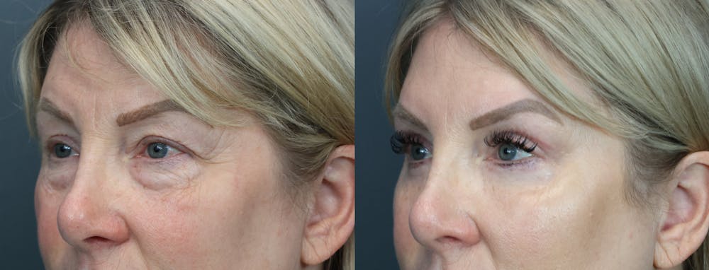 Eyelid Surgery Before & After Gallery - Patient 195436 - Image 2