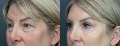 Eyelid Surgery Before & After Gallery - Patient 195436 - Image 2