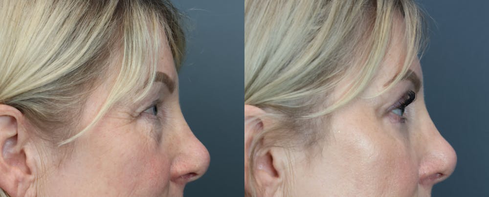 Eyelid Surgery Before & After Gallery - Patient 195436 - Image 4