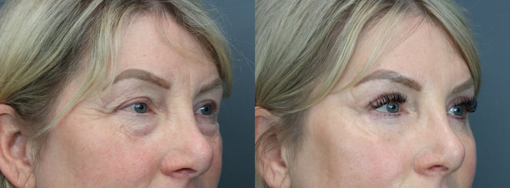 Eyelid Surgery Before & After Gallery - Patient 195436 - Image 3