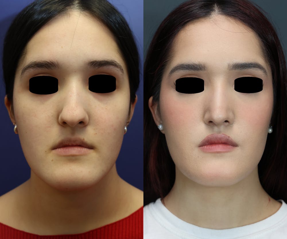 Rhinoplasty (Nose Reshaping) Before & After Gallery - Patient 400010 - Image 2