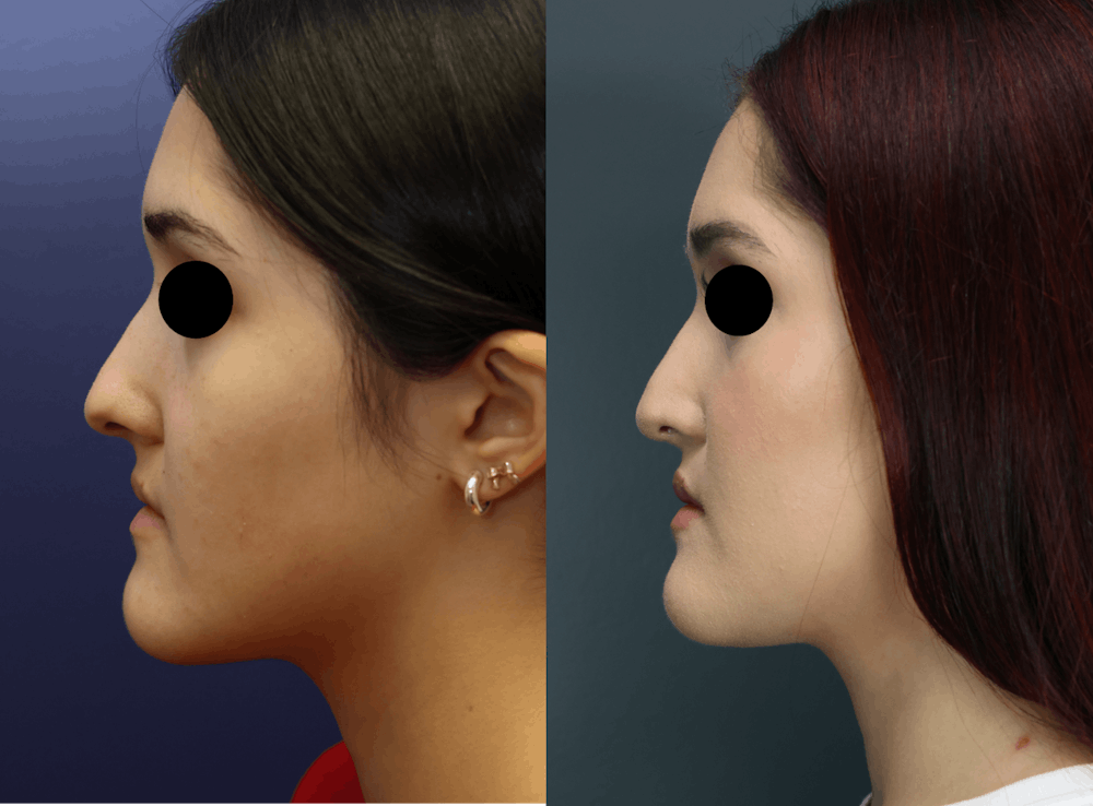 Rhinoplasty (Nose Reshaping) Before & After Gallery - Patient 400010 - Image 5