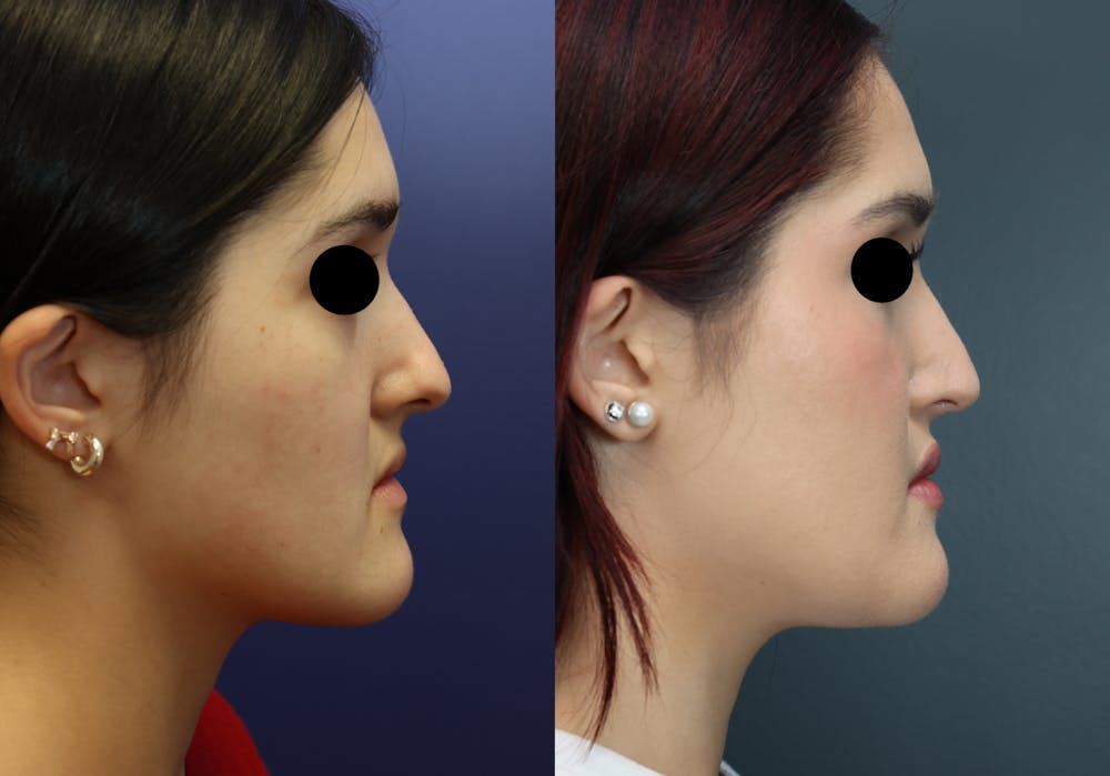 Rhinoplasty (Nose Reshaping) Before & After Gallery - Patient 400010 - Image 4