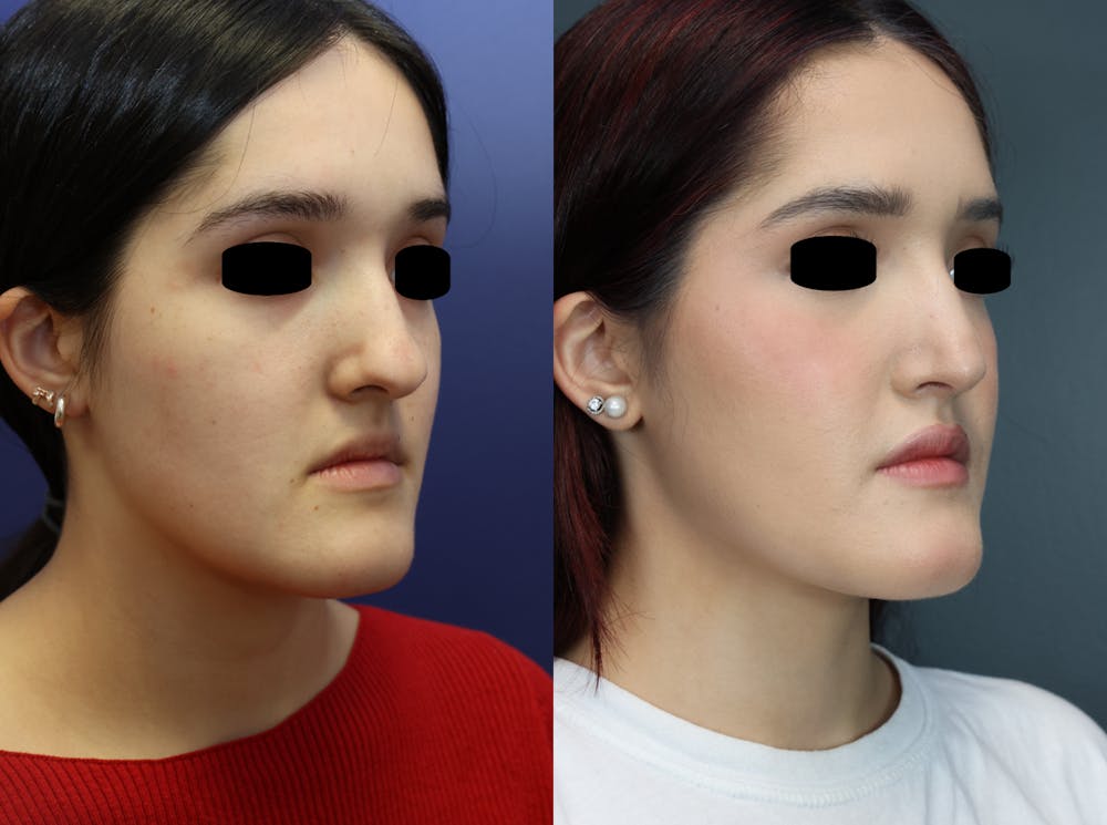 Rhinoplasty (Nose Reshaping) Before & After Gallery - Patient 400010 - Image 3