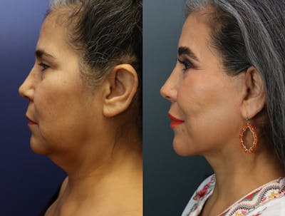 Deep Plane Neck Lift Before & After Gallery - Patient 298442 - Image 1
