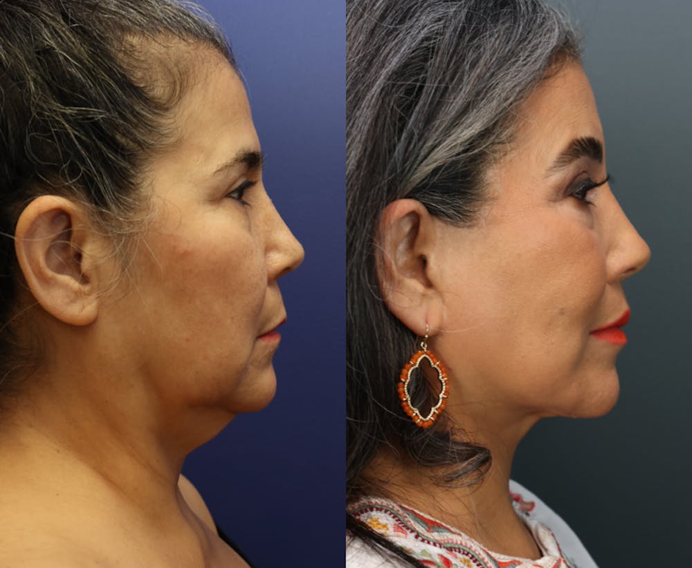 Deep Plane Neck Lift Before & After Gallery - Patient 298442 - Image 5