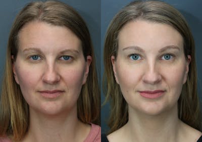 Brow Lift (Forehead Lift) Before & After Gallery - Patient 549721 - Image 1