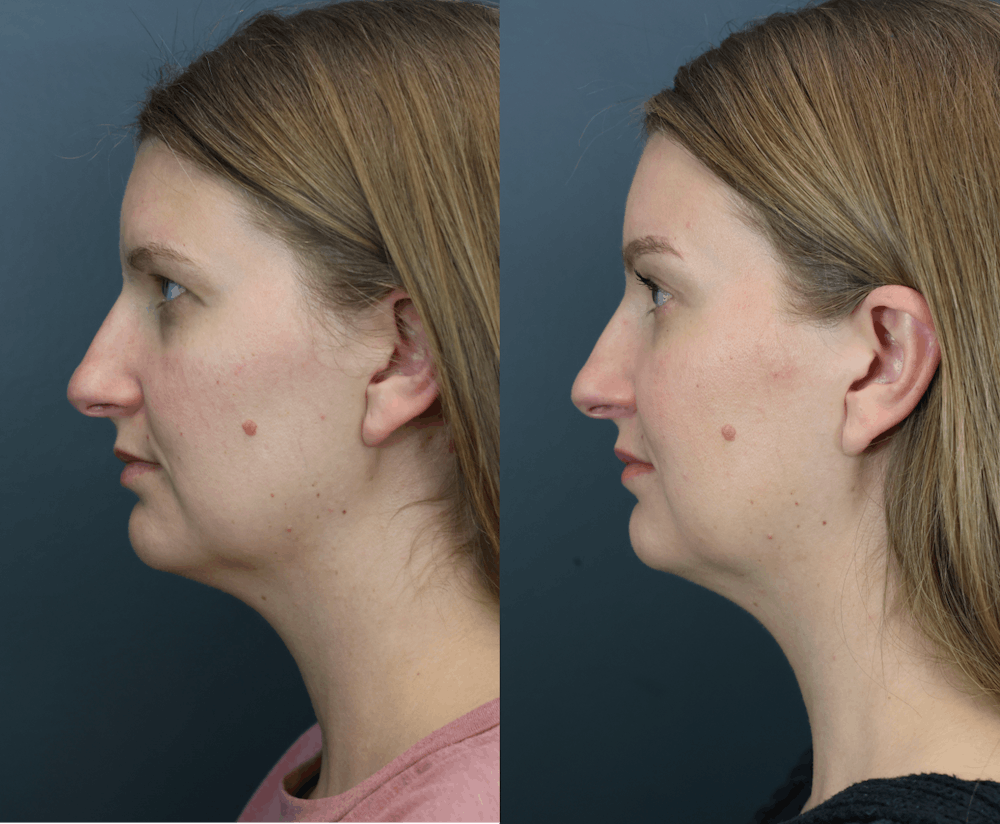 Eyelid Surgery Before & After Gallery - Patient 172548 - Image 4