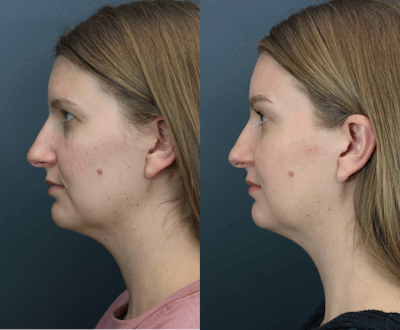 Eyelid Surgery Before & After Gallery - Patient 172548 - Image 4