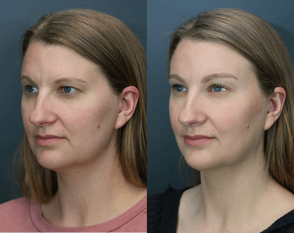 Eyelid Surgery Before & After Gallery - Patient 172548 - Image 2