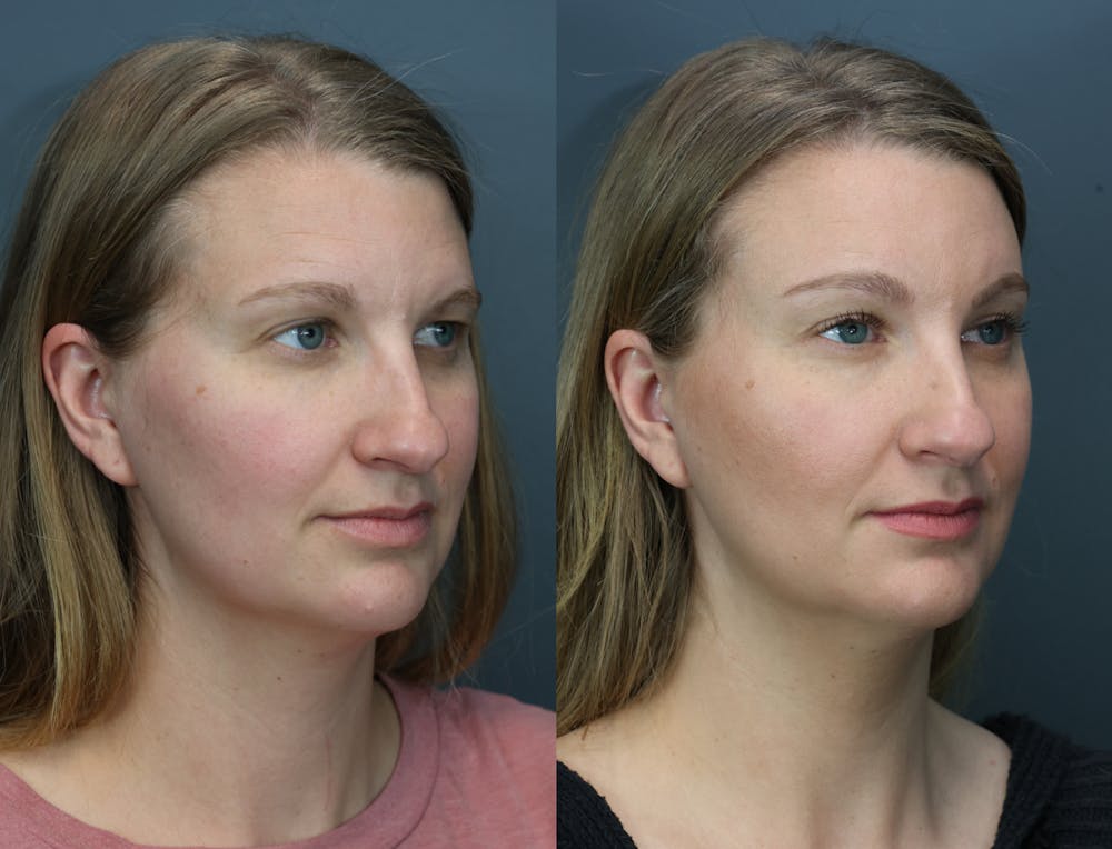 Eyelid Surgery Before & After Gallery - Patient 172548 - Image 3