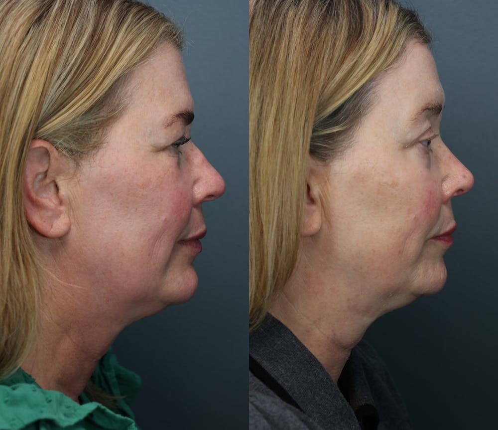 Rhinoplasty (Nose Reshaping) Before & After Gallery - Patient 933746 - Image 3