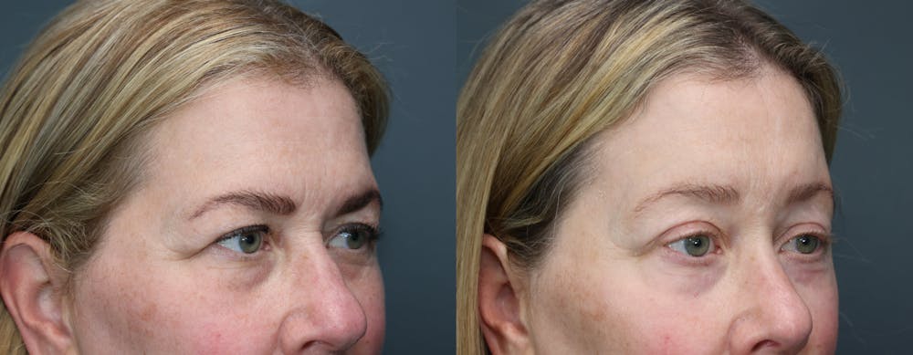 CO2 Laser Resurfacing Before & After Gallery - Patient 144155 - Image 3