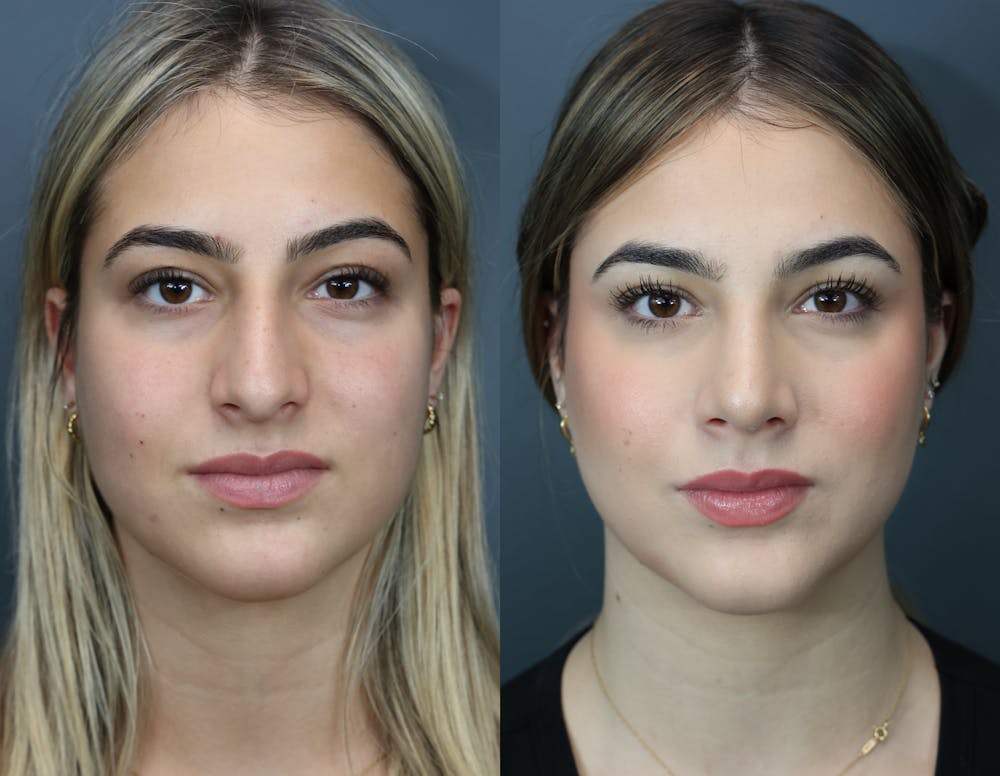Rhinoplasty (Nose Reshaping) Before & After Gallery - Patient 919224 - Image 5