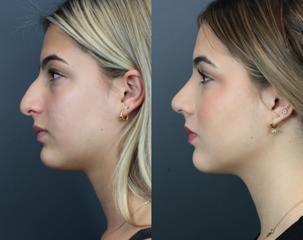Rhinoplasty (Nose Reshaping) Before & After Gallery - Patient 919224 - Image 2