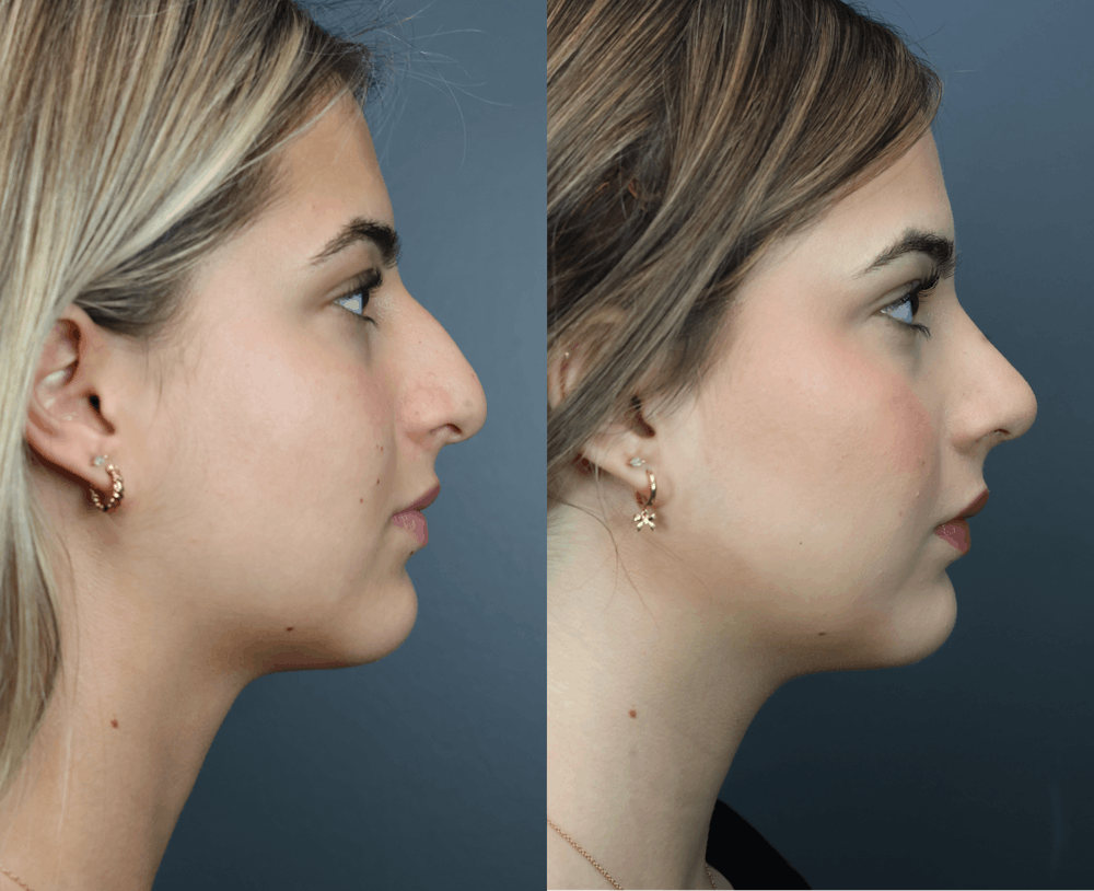 Rhinoplasty (Nose Reshaping) Before & After Gallery - Patient 919224 - Image 3