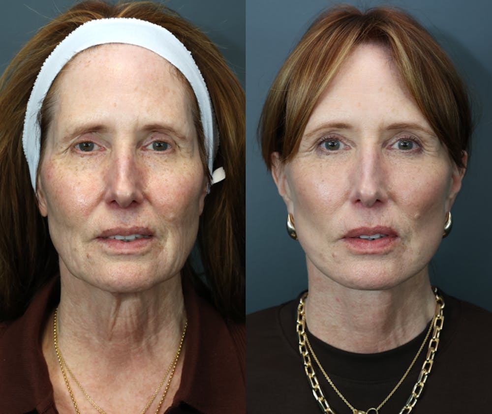 Facial Revolumizing (Fat Transfer) Before & After Gallery - Patient 370546 - Image 1