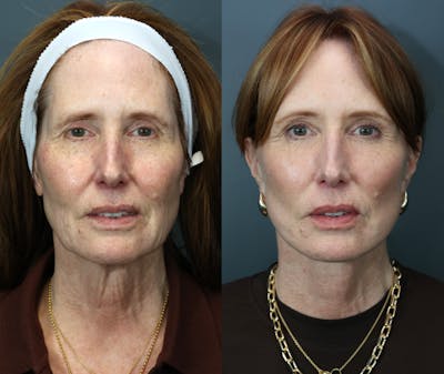 Deep Plane Neck Lift Before & After Gallery - Patient 157030 - Image 1