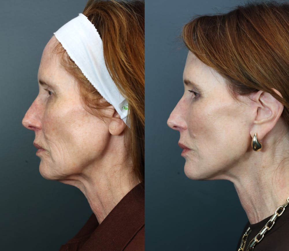 Facial Revolumizing (Fat Transfer) Before & After Gallery - Patient 370546 - Image 4