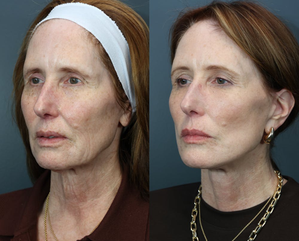 Facial Revolumizing (Fat Transfer) Before & After Gallery - Patient 370546 - Image 2