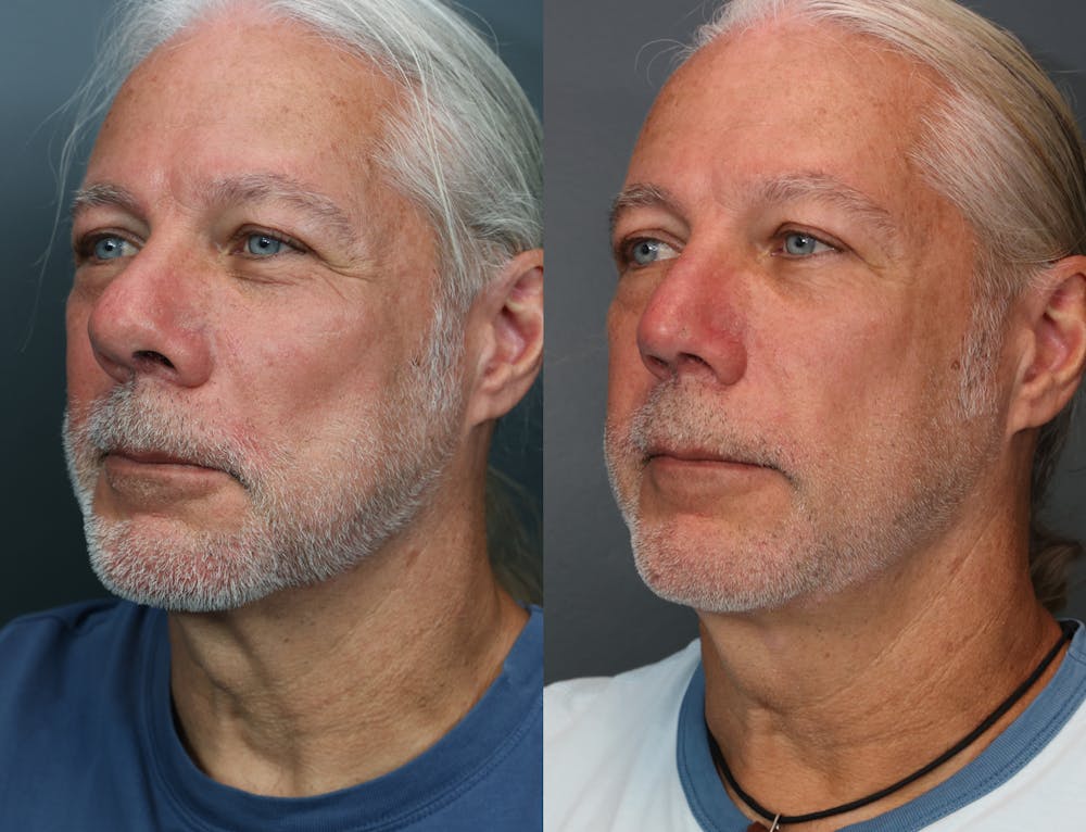 Rhinoplasty (Nose Reshaping) Before & After Gallery - Patient 510437 - Image 2