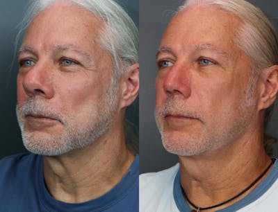 Rhinoplasty (Nose Reshaping) Before & After Gallery - Patient 510437 - Image 2