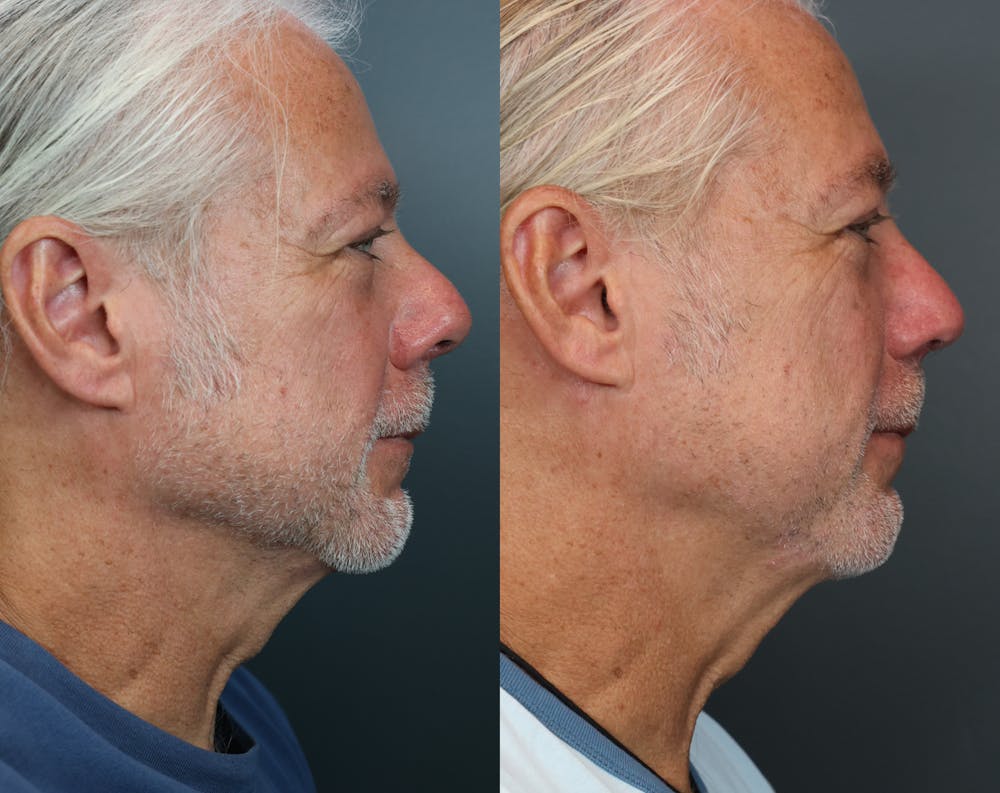 Rhinoplasty (Nose Reshaping) Before & After Gallery - Patient 510437 - Image 3