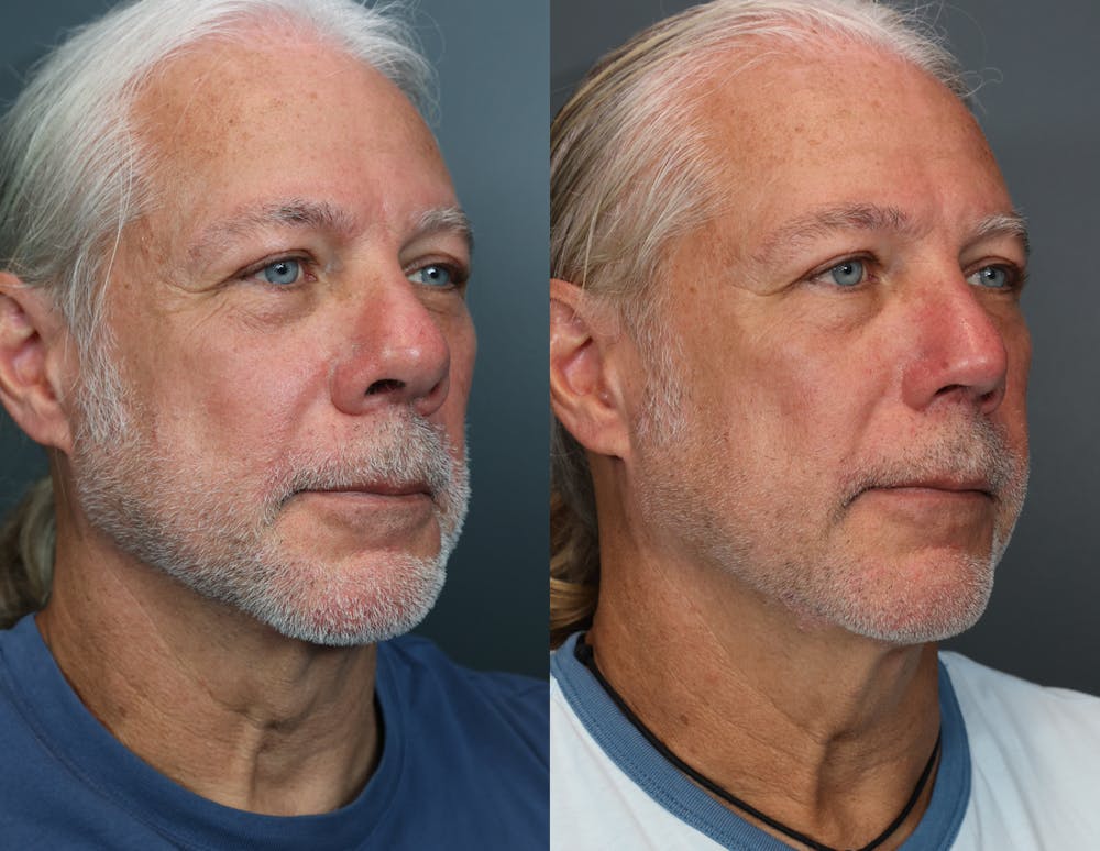 Rhinoplasty (Nose Reshaping) Before & After Gallery - Patient 510437 - Image 1