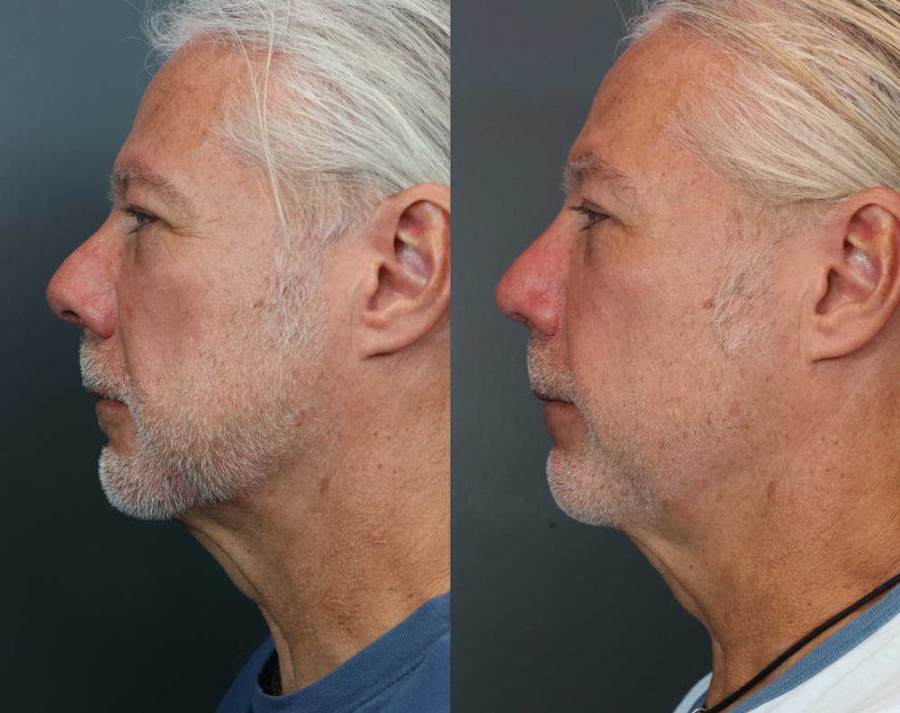 Rhinoplasty (Nose Reshaping) Before & After Gallery - Patient 510437 - Image 4