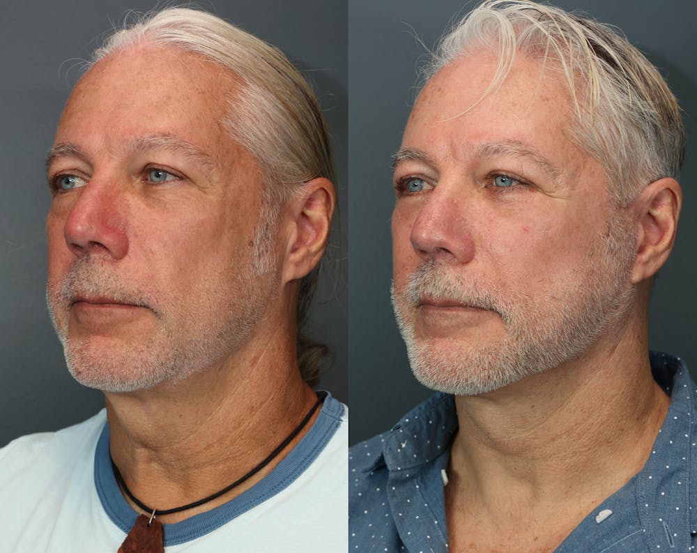 Deep Plane Facelift Before & After Gallery - Patient 525465 - Image 2