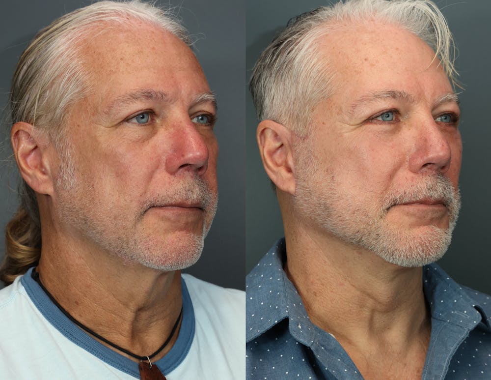 Deep Plane Facelift Before & After Gallery - Patient 525465 - Image 1