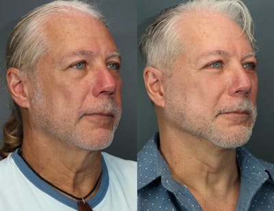 Deep Plane Neck Lift Before & After Gallery - Patient 417233 - Image 1
