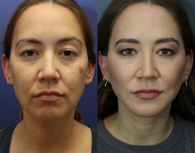 Deep Plane Neck Lift Before & After Gallery - Patient 114655 - Image 1