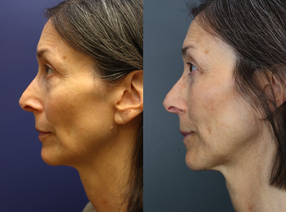 Facial Revolumizing (Fat Transfer) Before & After Gallery - Patient 391502 - Image 3