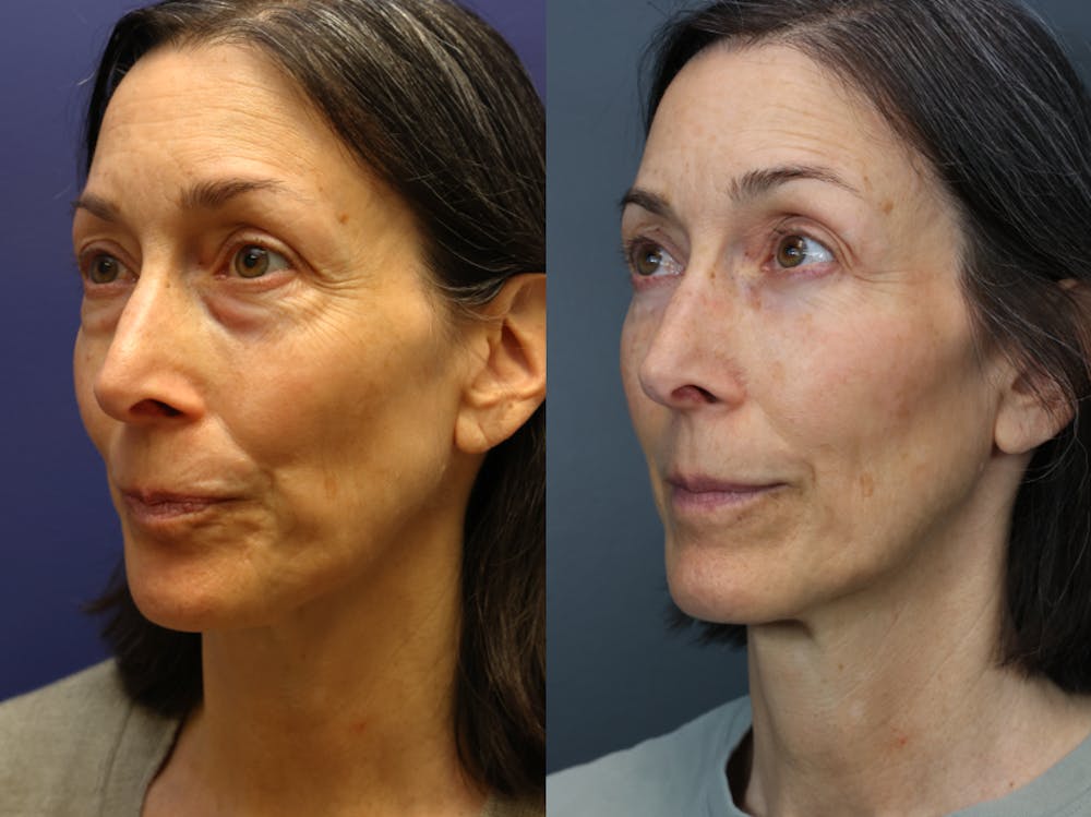 Facial Revolumizing (Fat Transfer) Before & After Gallery - Patient 391502 - Image 2