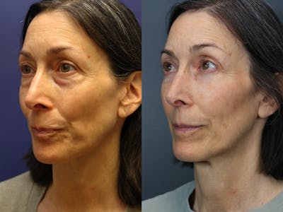 Facial Revolumizing (Fat Transfer) Before & After Gallery - Patient 391502 - Image 2