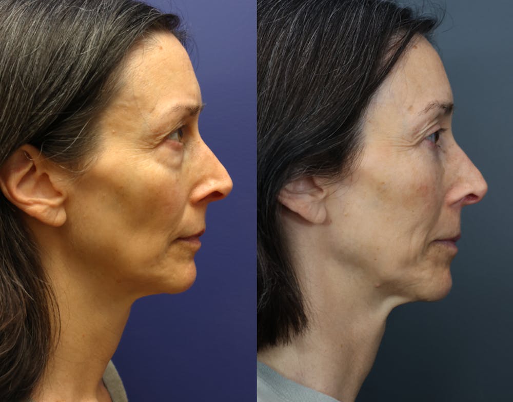 Facial Revolumizing (Fat Transfer) Before & After Gallery - Patient 391502 - Image 5