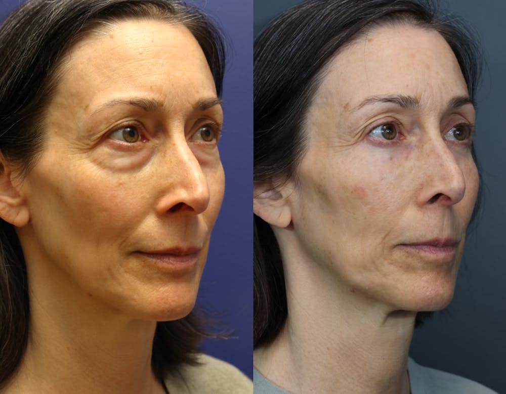 Facial Revolumizing (Fat Transfer) Before & After Gallery - Patient 391502 - Image 4