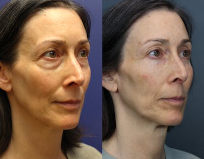 Facial Revolumizing (Fat Transfer) Before & After Gallery - Patient 391502 - Image 4