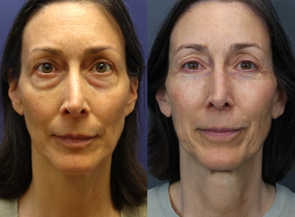 Facial Revolumizing (Fat Transfer) Before & After Gallery - Patient 391502 - Image 1
