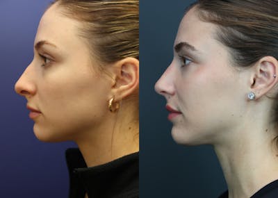 Rhinoplasty (Nose Reshaping) Before & After Gallery - Patient 175171333 - Image 2