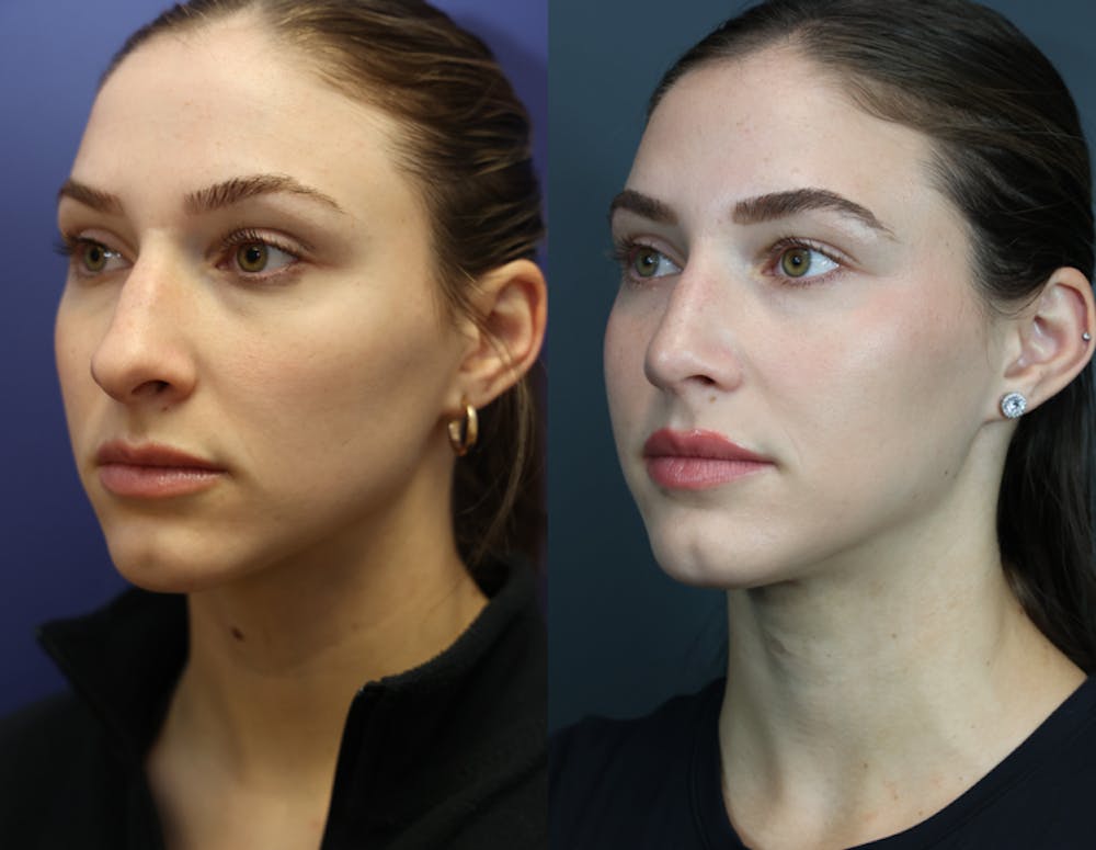 Rhinoplasty (Nose Reshaping) Before & After Gallery - Patient 175171333 - Image 1