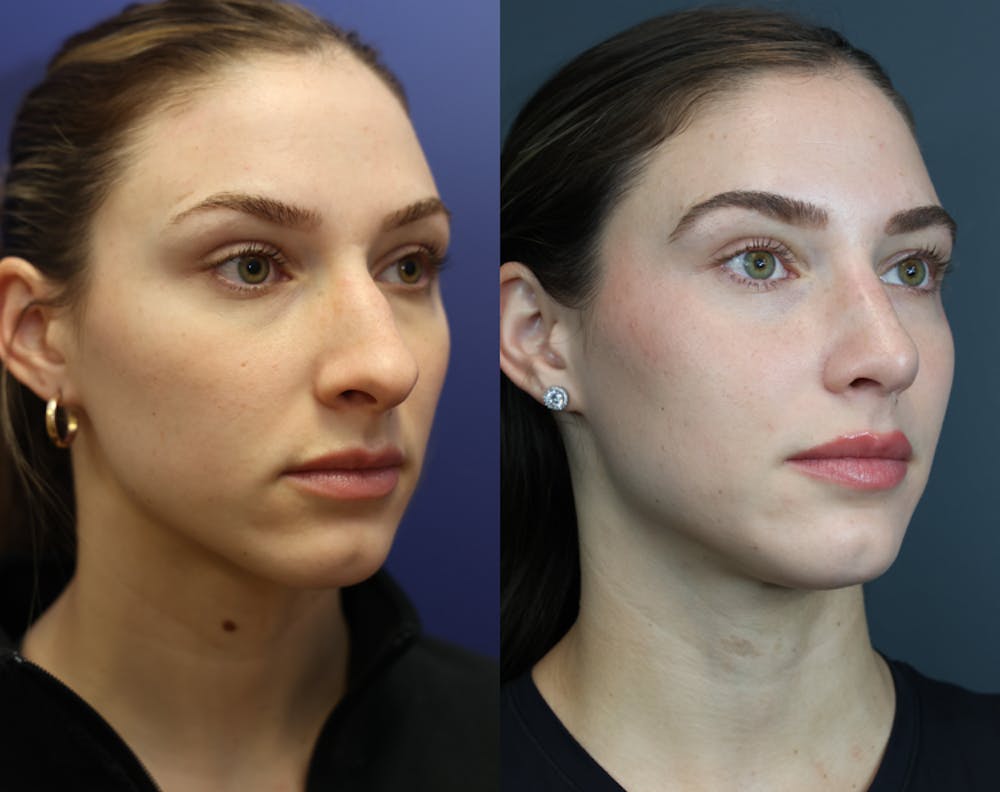 Rhinoplasty (Nose Reshaping) Before & After Gallery - Patient 175171333 - Image 4