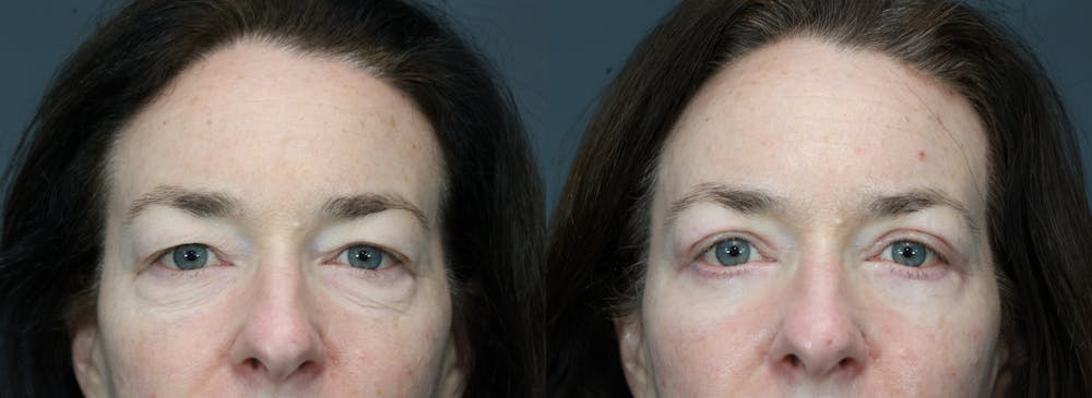 Eyelid Surgery Before & After Gallery - Patient 134729 - Image 1