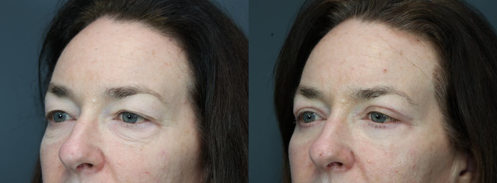 Eyelid Surgery Before & After Gallery - Patient 134729 - Image 2