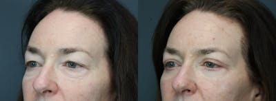Eyelid Surgery Before & After Gallery - Patient 134729 - Image 2
