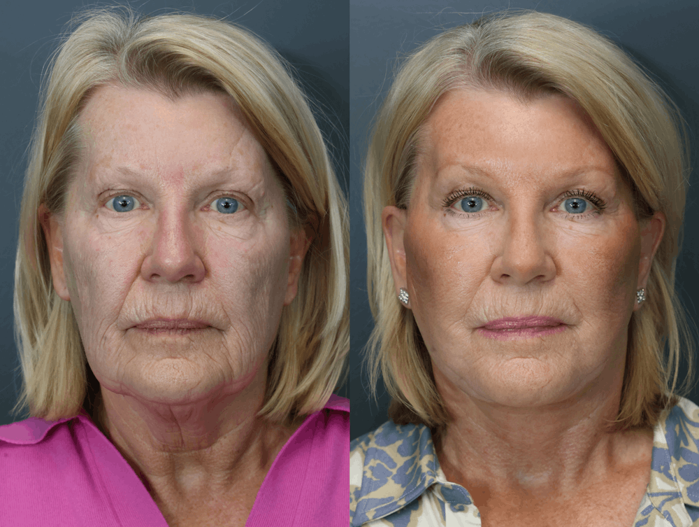 Brow Lift (Forehead Lift) Before & After Gallery - Patient 281857 - Image 3